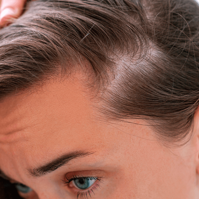 Alopecia asociada a cuero cabelludo graso