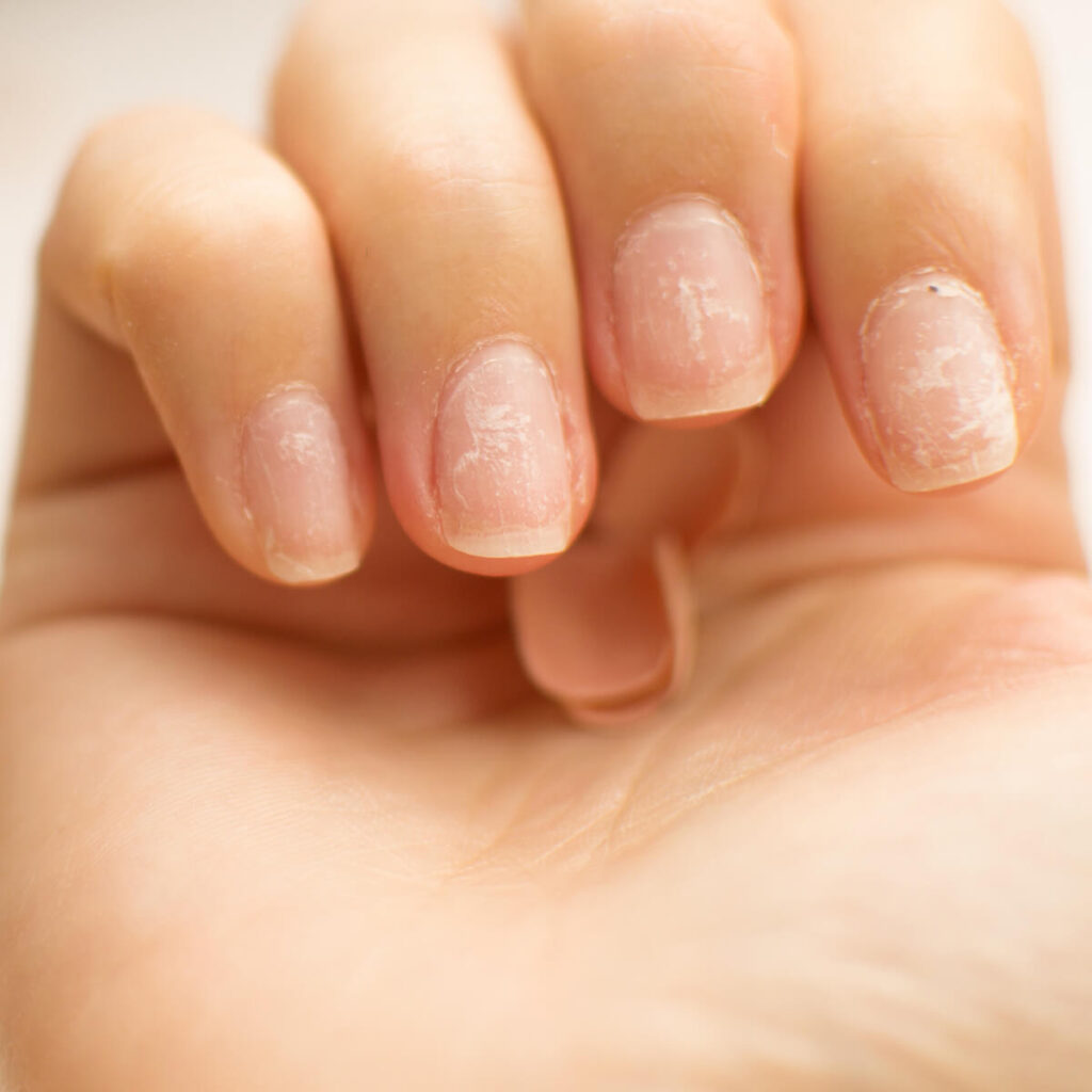 Brittle nails - Pilopeptan ®