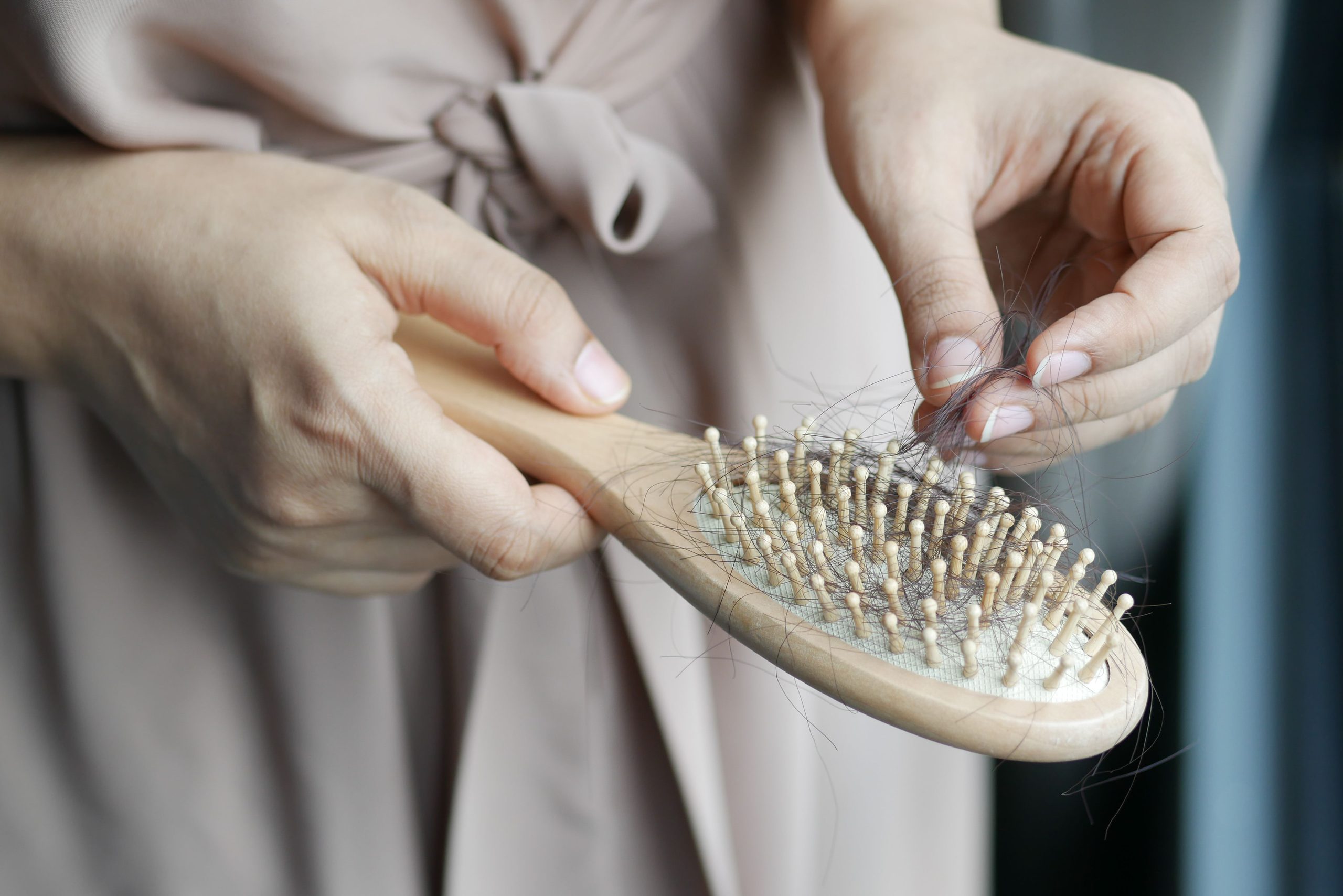 Types of female alopecia